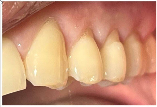 Before Composite Filings