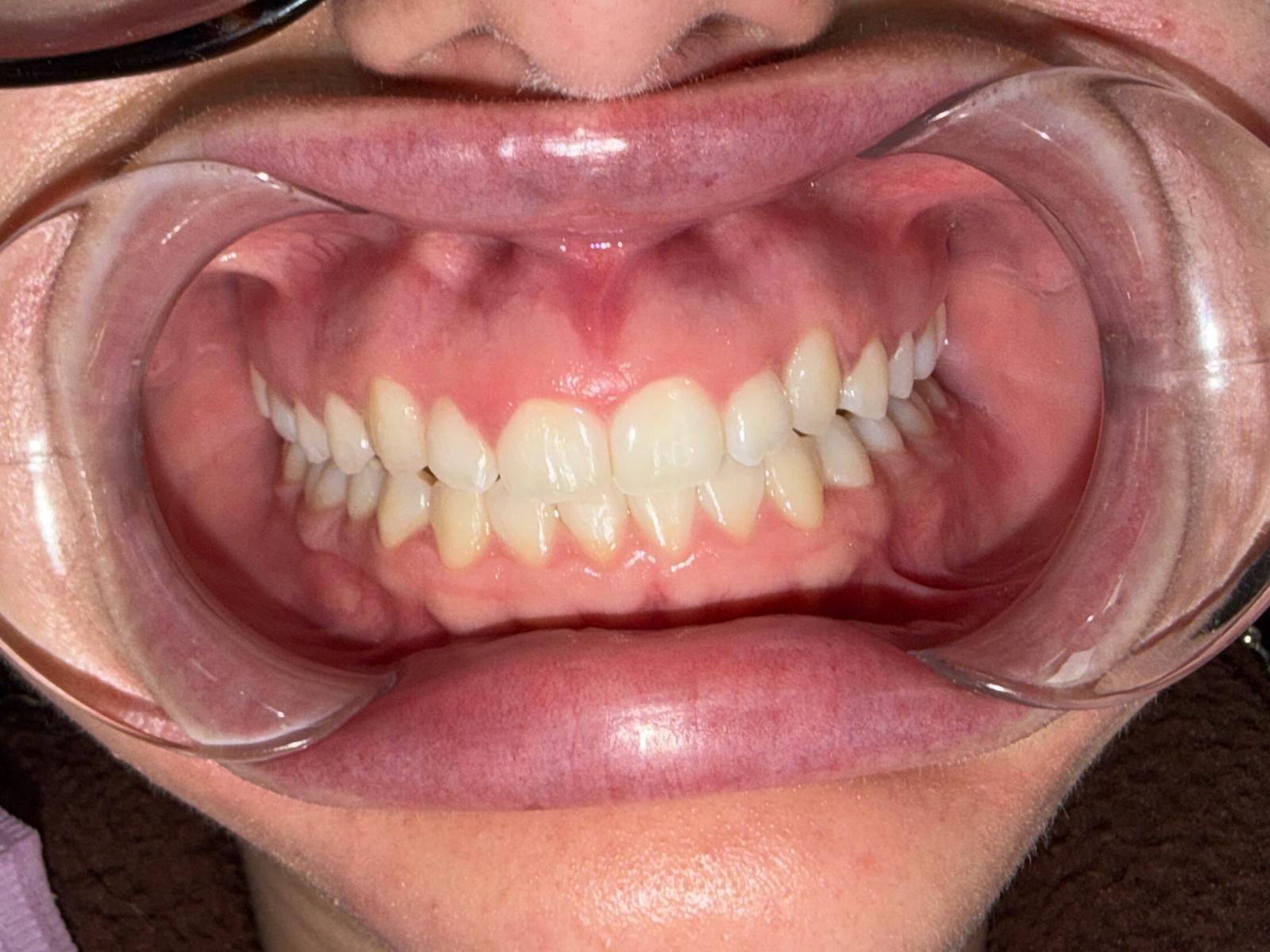 After: Smile Alignment & Bonding