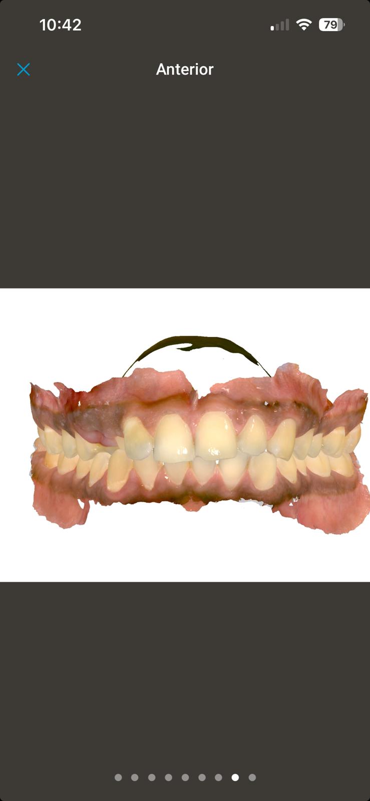 Before: Smile Alignment & Bonding