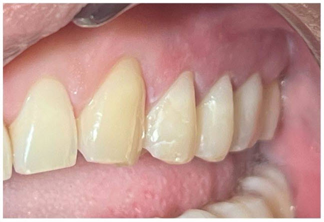 After - Composite Filings