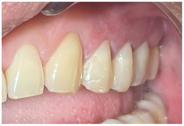 After: Composite Restorations