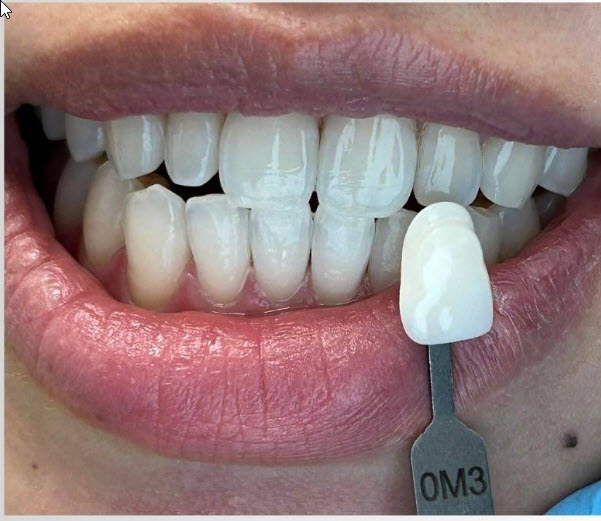 After - Professional Teeth Whitening