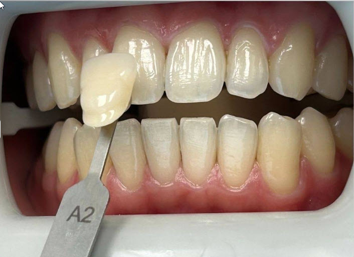 Before - Professional Teeth Whitening